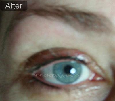 Permanent Makep of Eye Liner - After