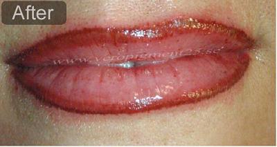 Permanent Makeup of Lip Liner - After