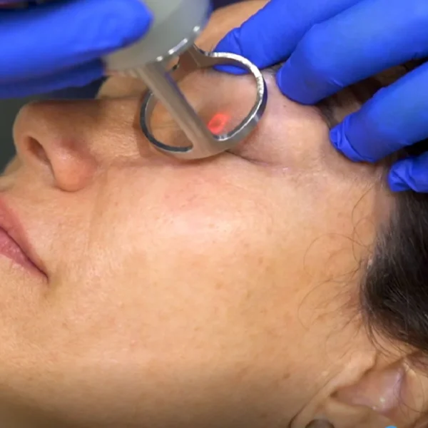 Fraktionerad CO2 Laser