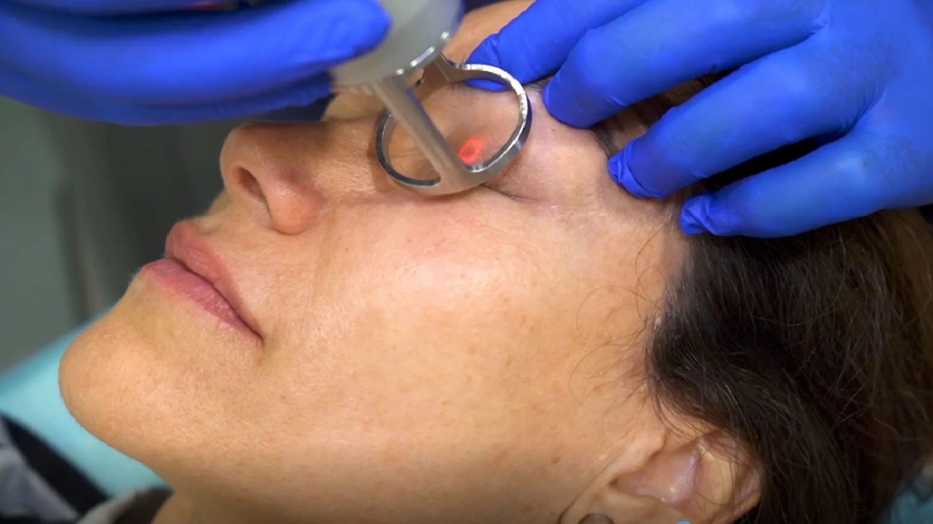 Fraktionerad CO2 Laser