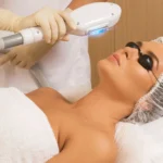 IPL Laser - Ansikte