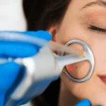 Ansikte - Co2 Laser Fractional